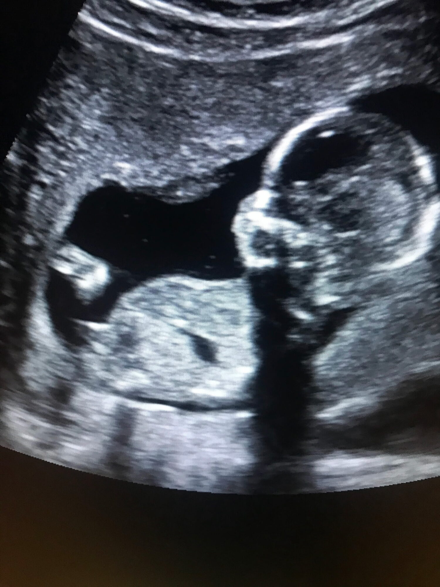 Ultrasound image showing a developing fetus in the womb, with visible head and body structures.