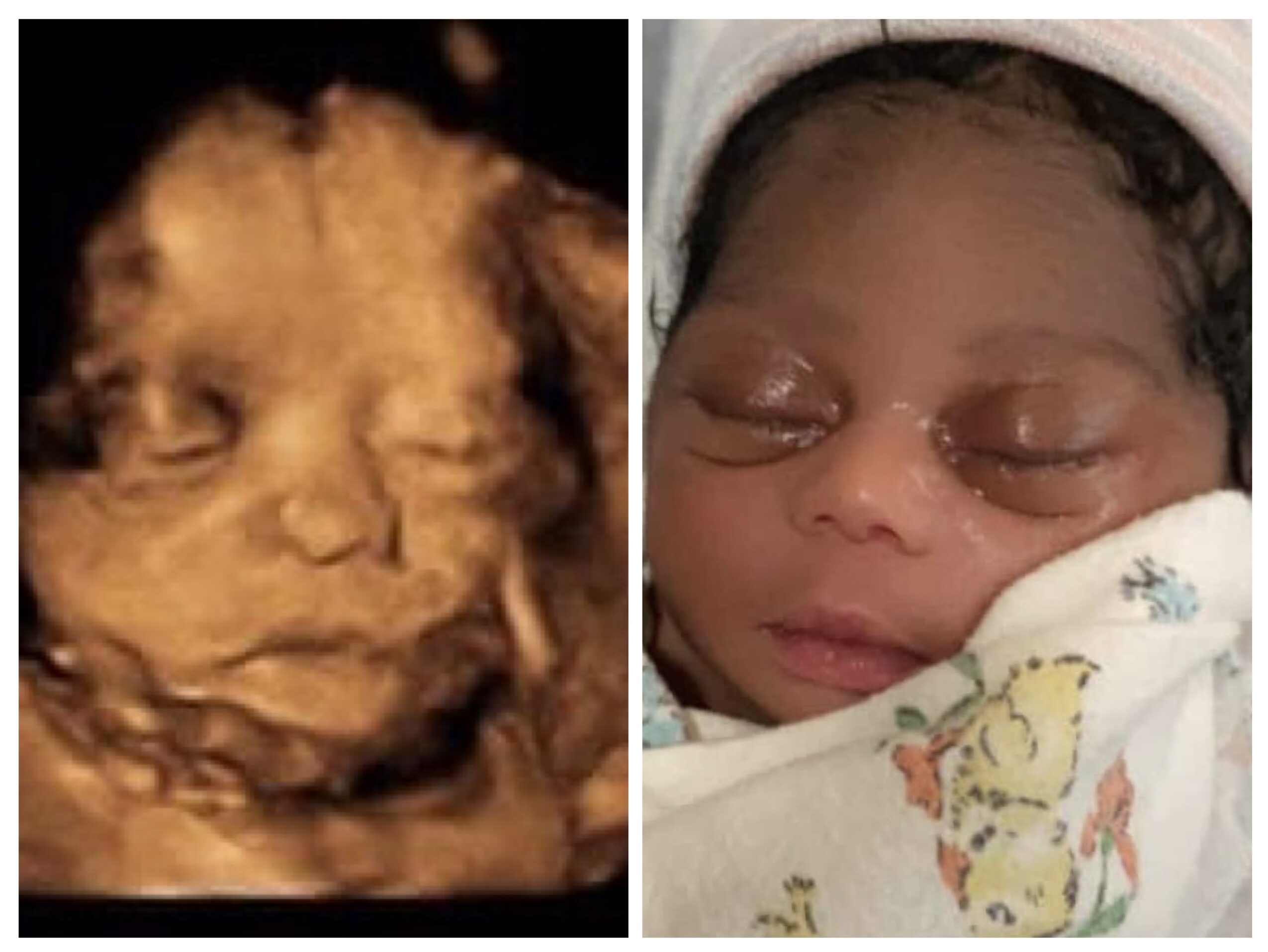 Side-by-side images of a 3D ultrasound of a fetus and a newborn baby sleeping, wrapped in a blanket.