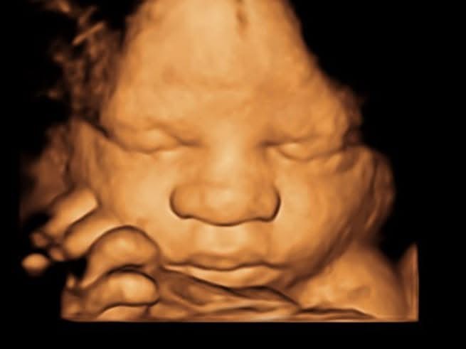 Ultrasound image of a developing fetus with detailed facial features, hand near face, in warm brown tones.