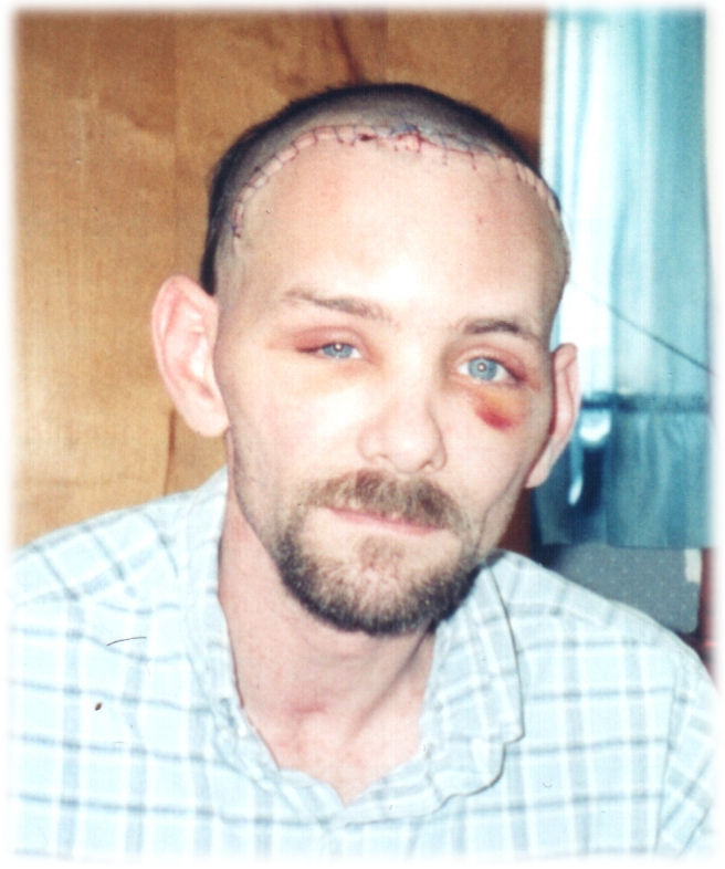 Man with a stitched forehead, facial injuries, and a beard, wearing a checkered shirt, sitting indoors with a wooden wall and blue curtain in background.