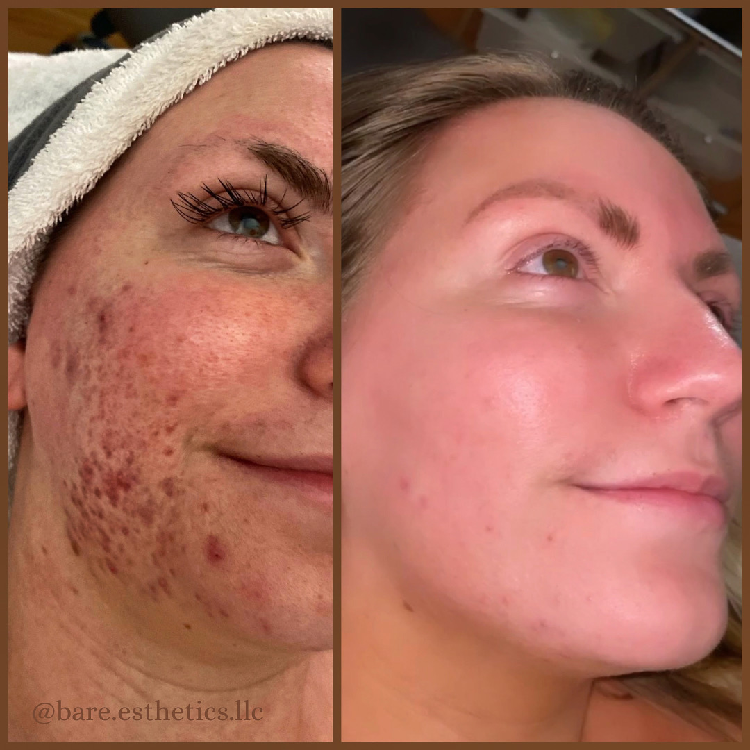 Side-by-side comparison of a woman's face showing improvement in skin clarity and texture after treatment.
