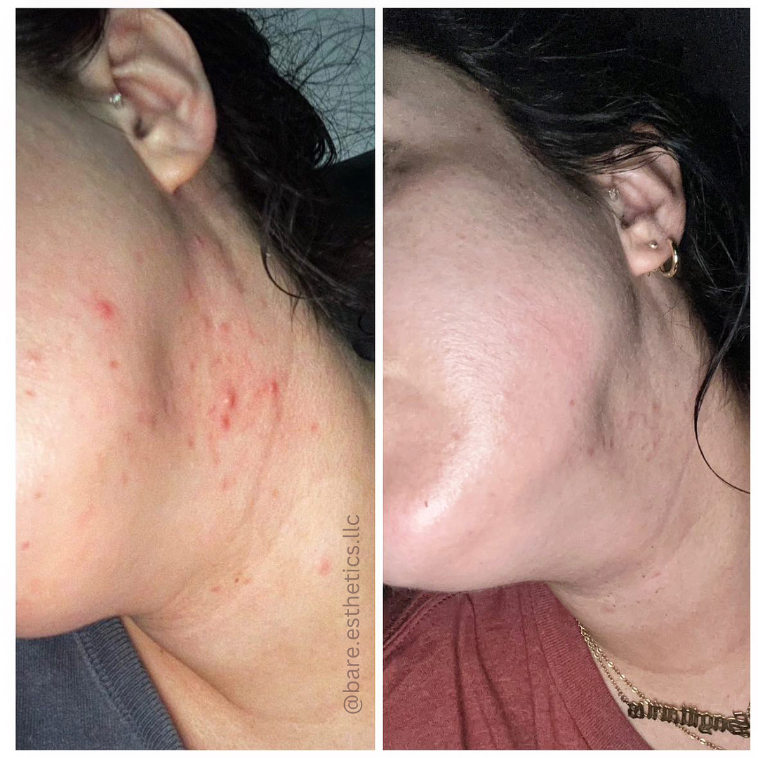 Side-by-side images of a person's cheek showing skin improvement, with visible acne scars and clearer skin after treatment.