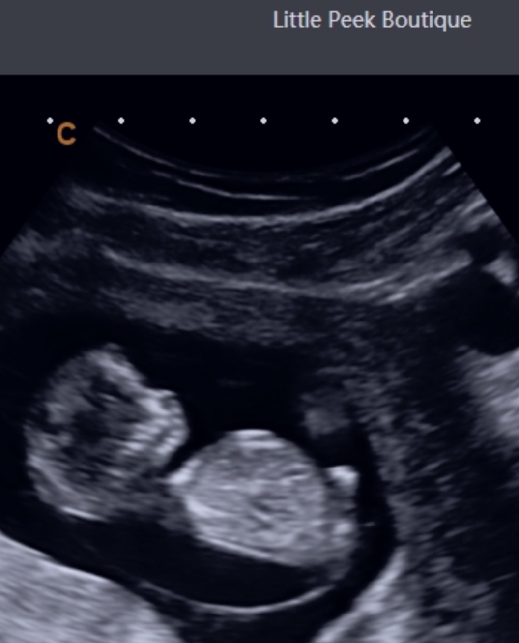 Ultrasound image showing a developing fetus in the womb with head and body visible.