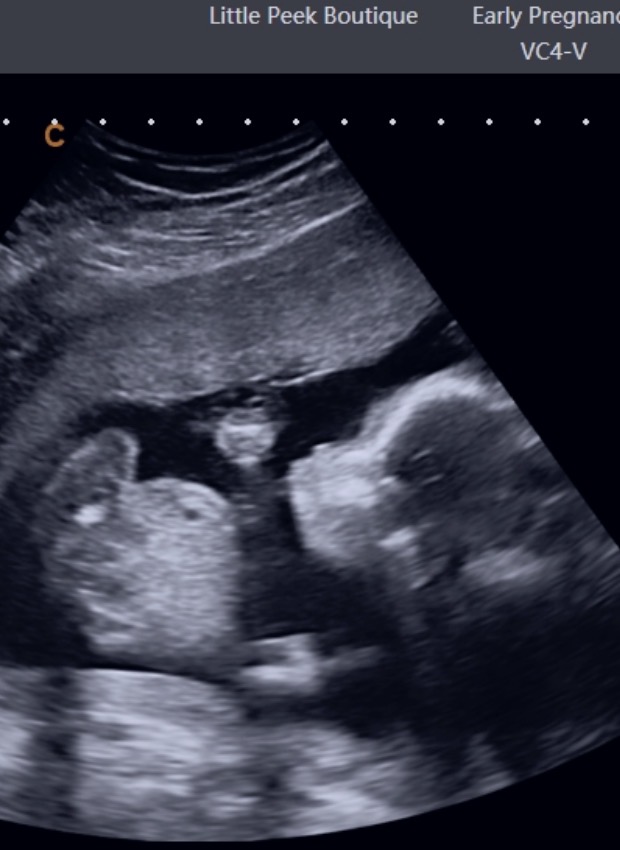 Ultrasound image showing a developing fetus in the womb with head and body visible.
