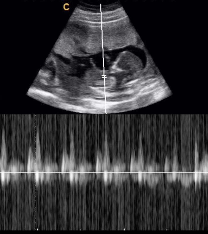 Ultrasound image showing a fetus in the womb with a Doppler waveform below, indicating blood flow.
