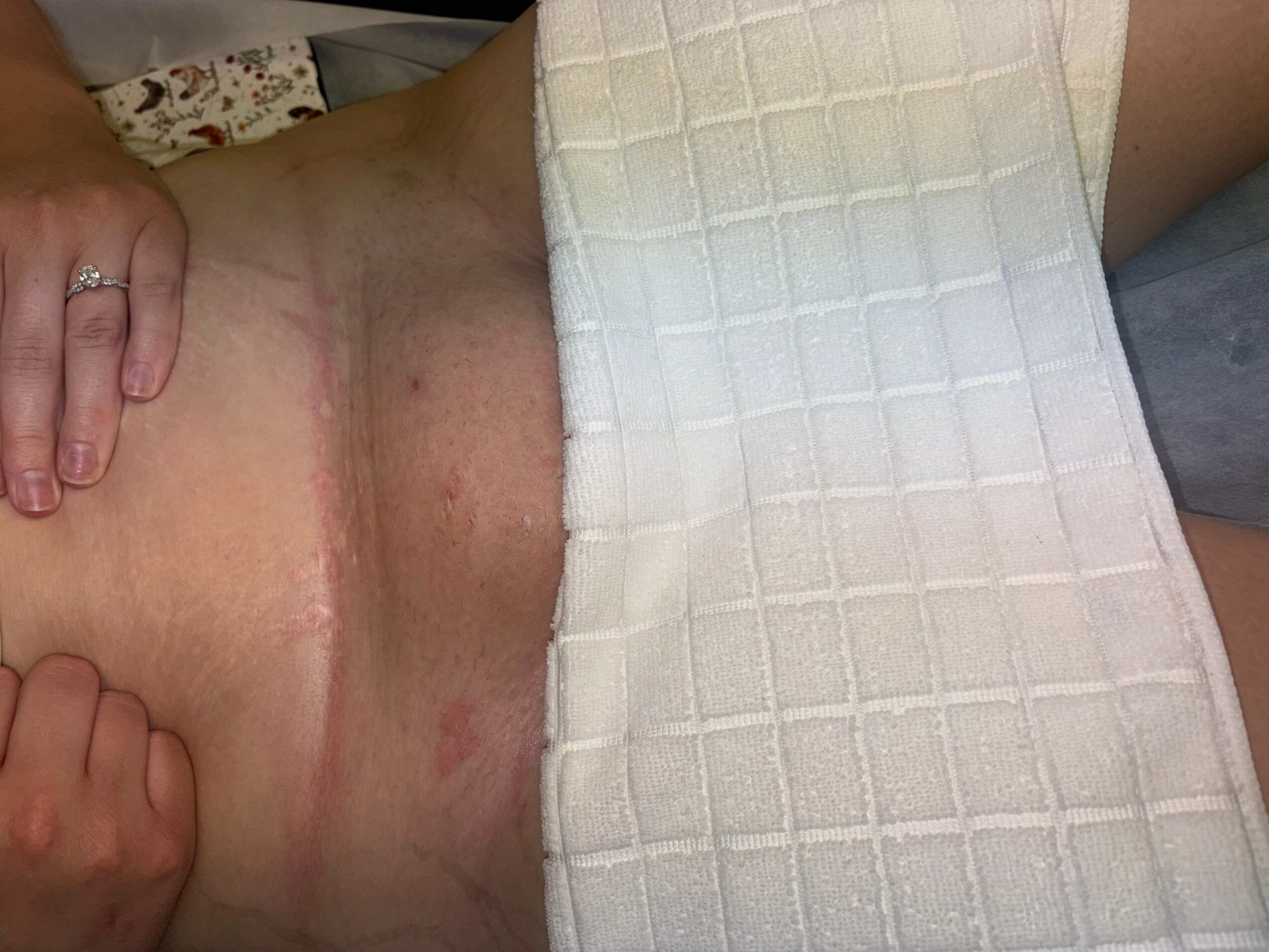 Close-up of a person's lower abdomen with skin irritation and redness, partially covered by a white textured cloth.