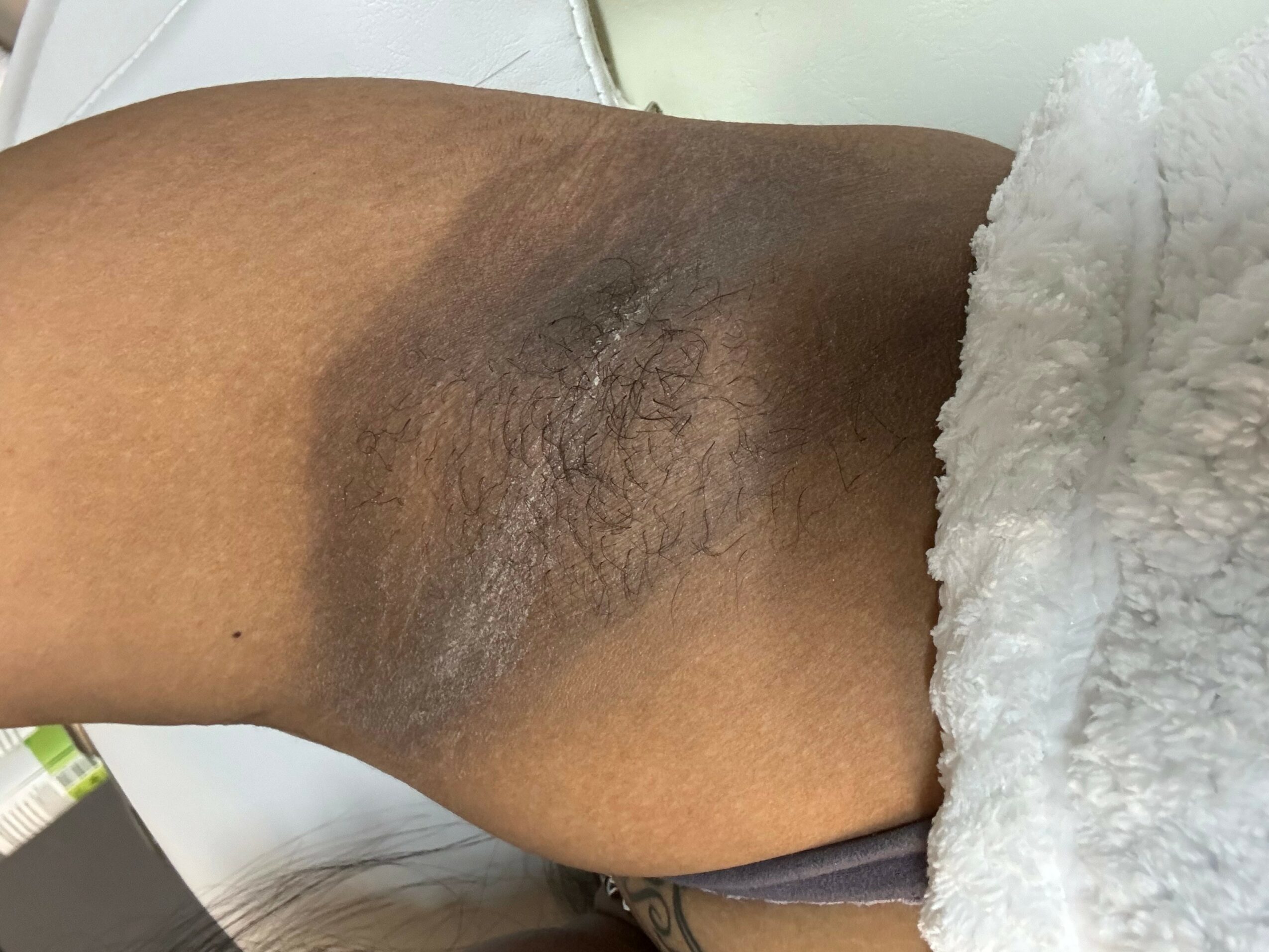 Close-up of a person's armpit with dark hair and skin discoloration, partially covered by a white towel.
