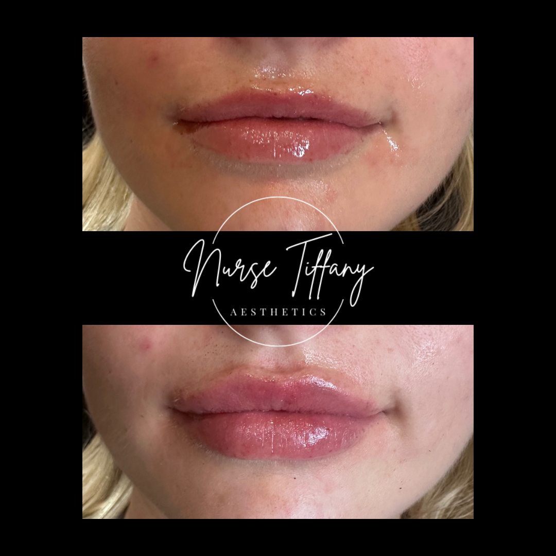 Close-up of lips before and after cosmetic enhancement, with glossy finish and smooth appearance, black background with white text overlay.