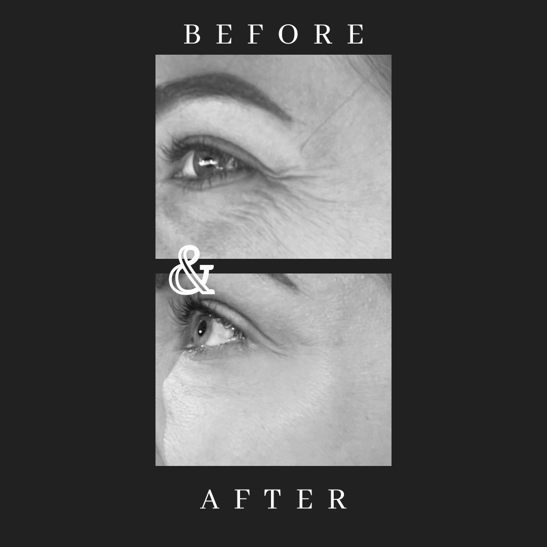 Close-up of eye wrinkles before and after treatment, with text 'BEFORE' and 'AFTER' above and below the images.