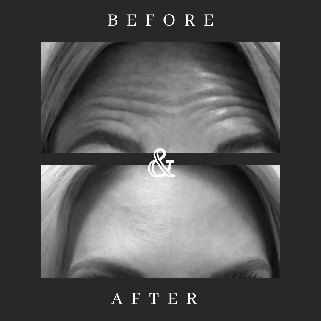 Black and white image showing forehead wrinkles before and smooth after skin treatment, with text labels.