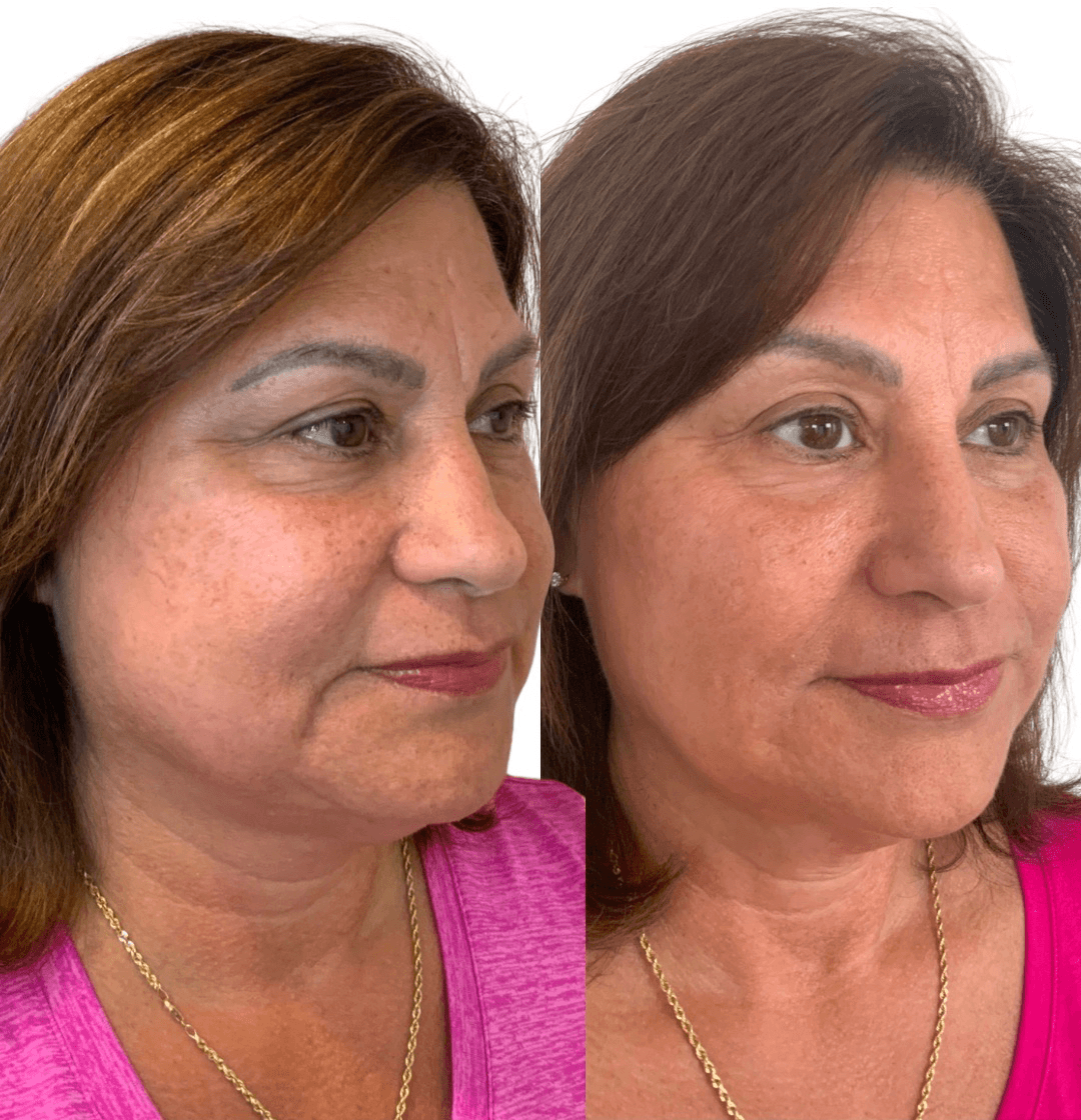Side-by-side images of a woman before and after skincare, showing improved skin texture and tone, wearing a pink top and gold necklace.