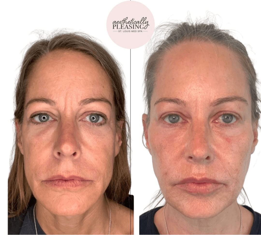 Side-by-side images of a woman before and after skincare treatment, showing facial skin changes and improved appearance.